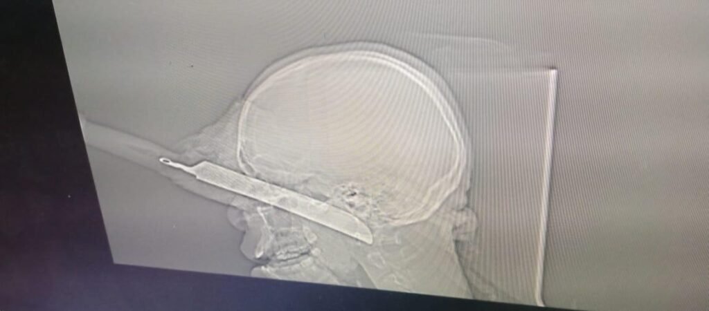 Profissionais do Josina Machel salvam vida de jovem atingido com faca de 50 cm no olho